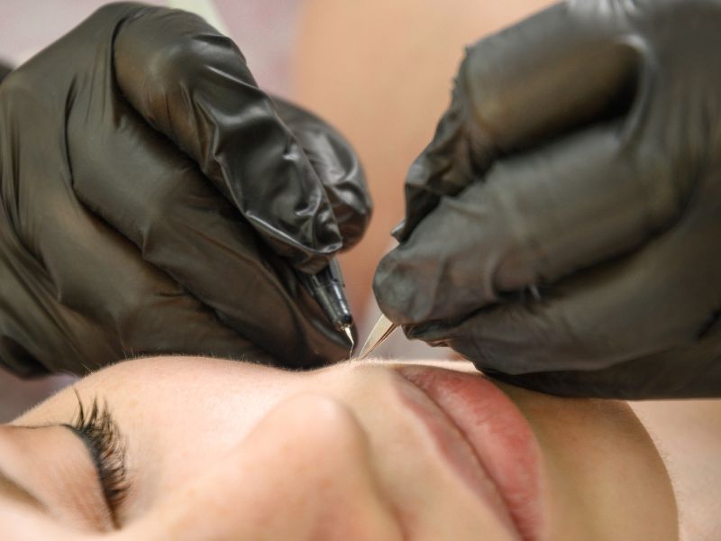 Close-up of precision hair removal using gloved hands and a fine probe.