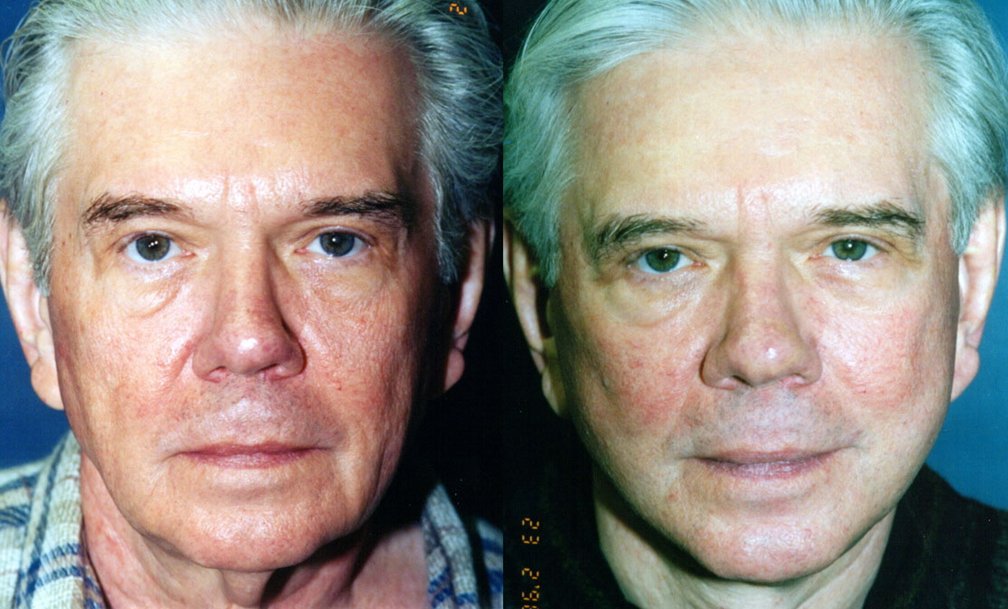 Facelift before and after photographs, case 12, with the before photograph on the left and the after photograph on the right