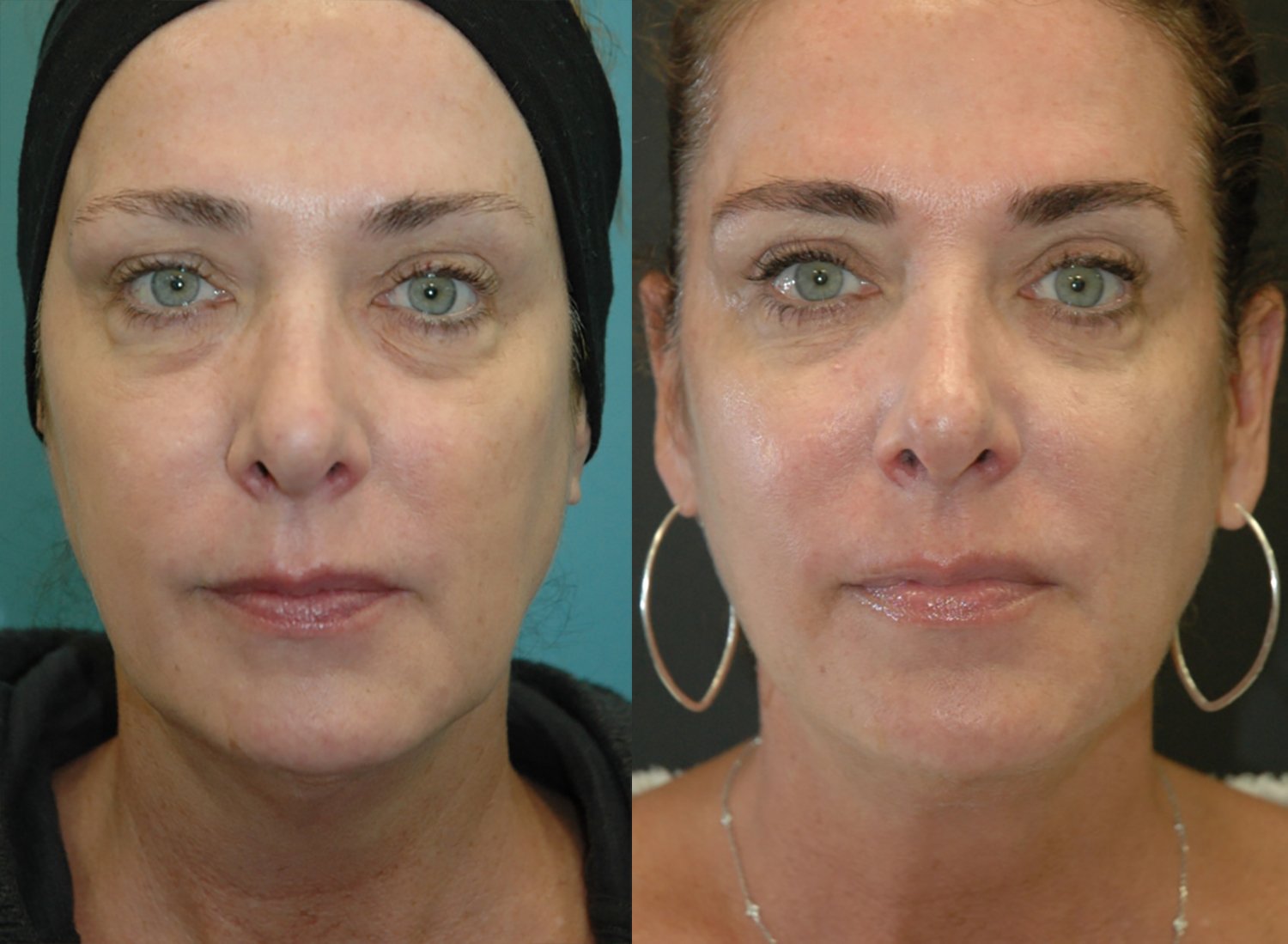 Morpheus8 with FaceTite before and after photographs, case 5, with the before photograph on the left and the after photograph on the right