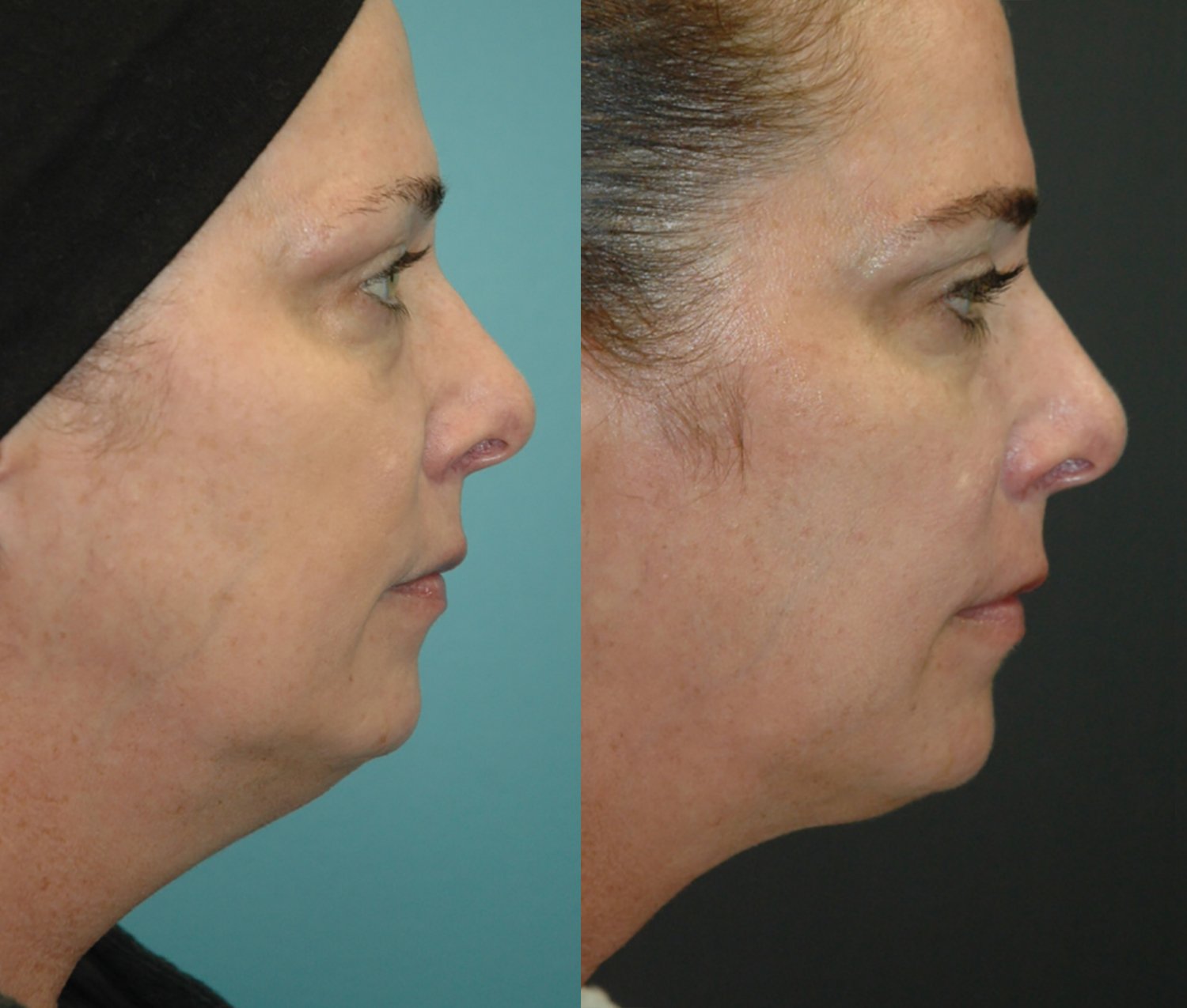 Morpheus8 with FaceTite before and after photographs, case 11, with the before photograph on the left and the after photograph on the right