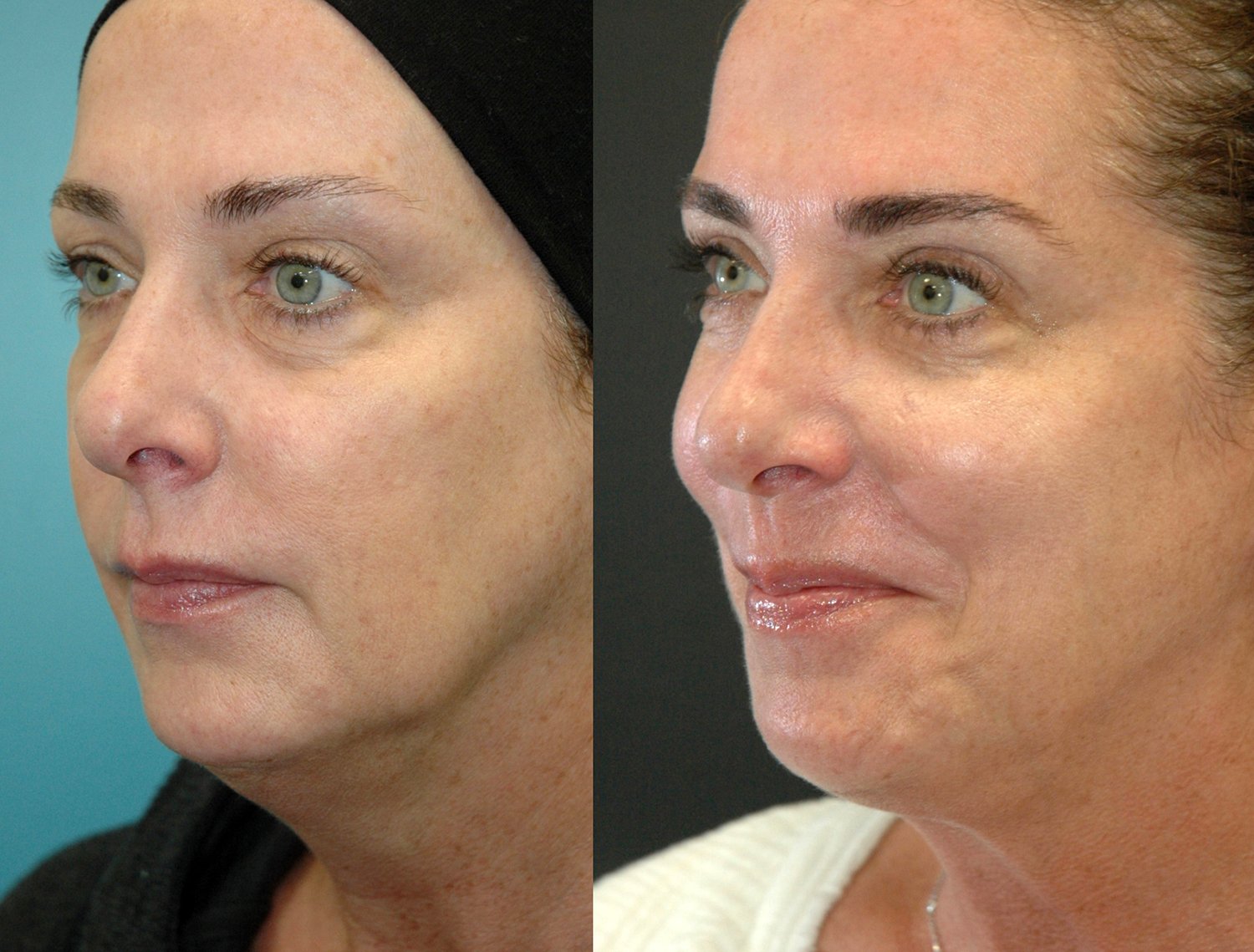 Morpheus8 with FaceTite before and after photographs, case 4, with the before photograph on the left and the after photograph on the right