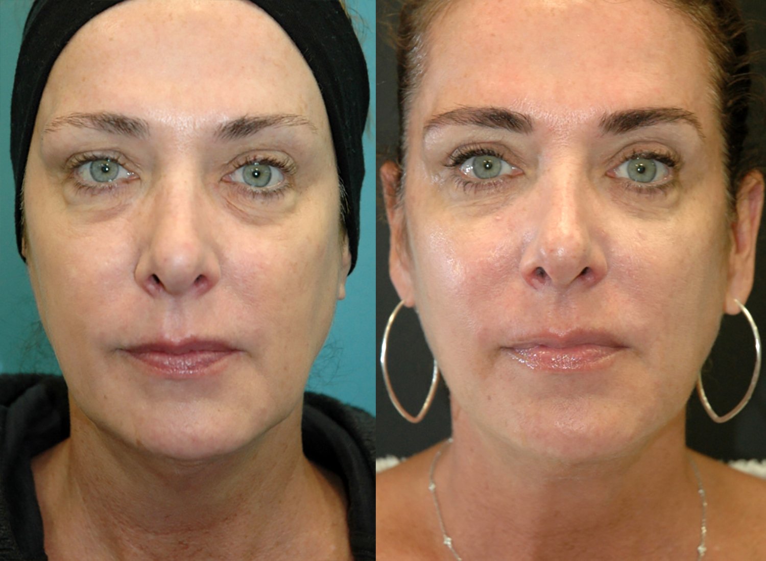 Morpheus8 with FaceTite before and after photographs, case 3, with the before photograph on the left and the after photograph on the right