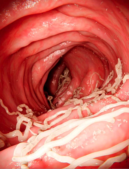 Imagen endoscópica de Ascaris lumbricoides en el intestino