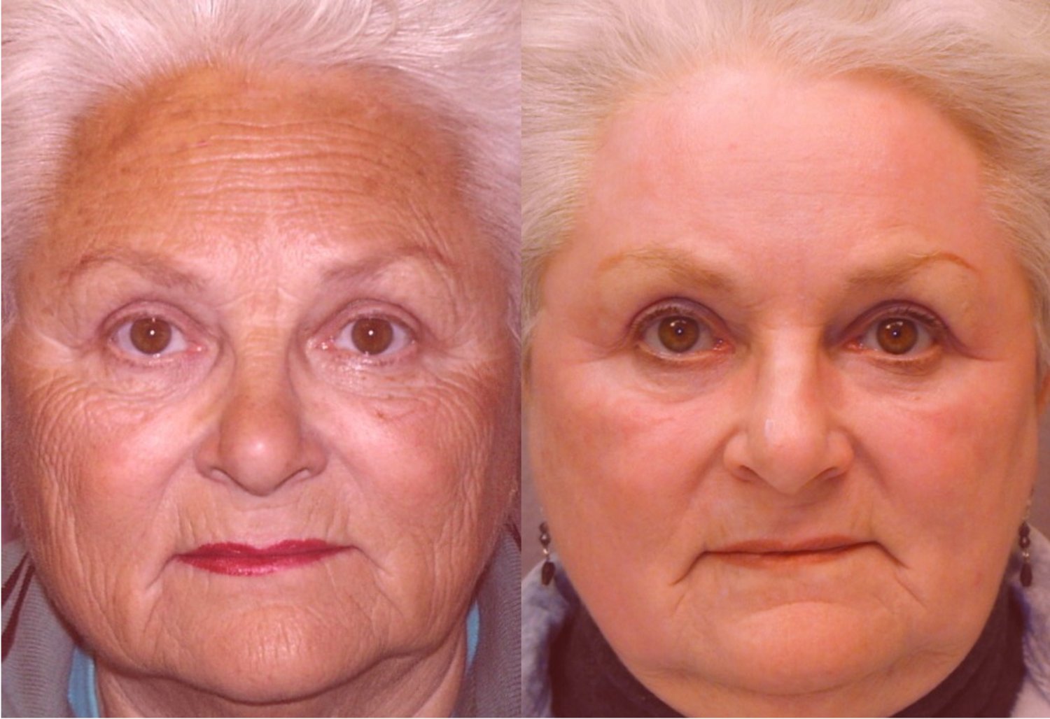 Full-face laser resurfacing before and after photographs, case 1, with the before photograph on the left and the after photograph on the right