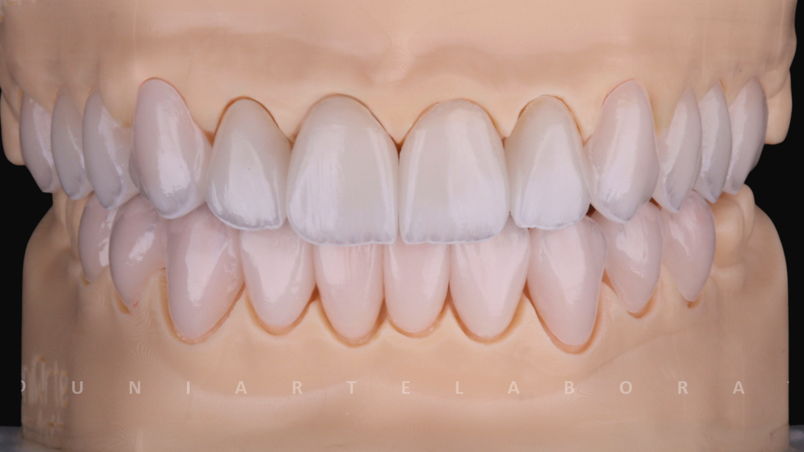 Lentes de contato dental natural - Trabalho Uniarte