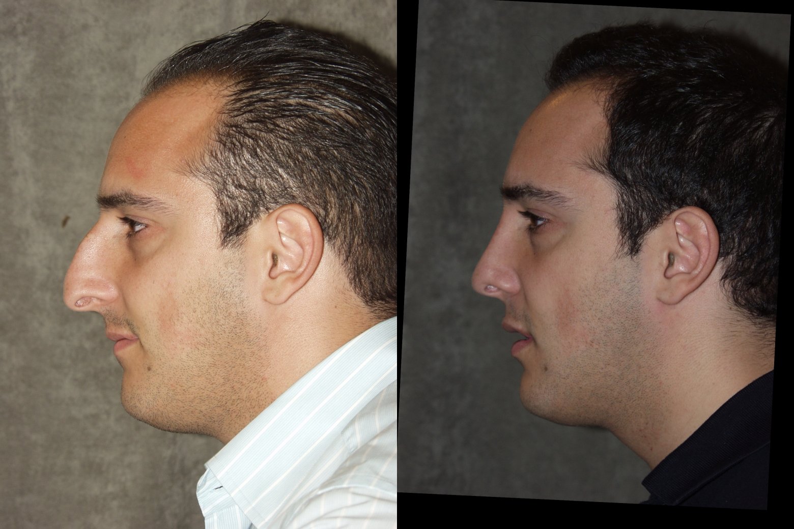 Rhinoplasty before and after photographs, case 6, with the before photograph on the left and the after photograph on the right