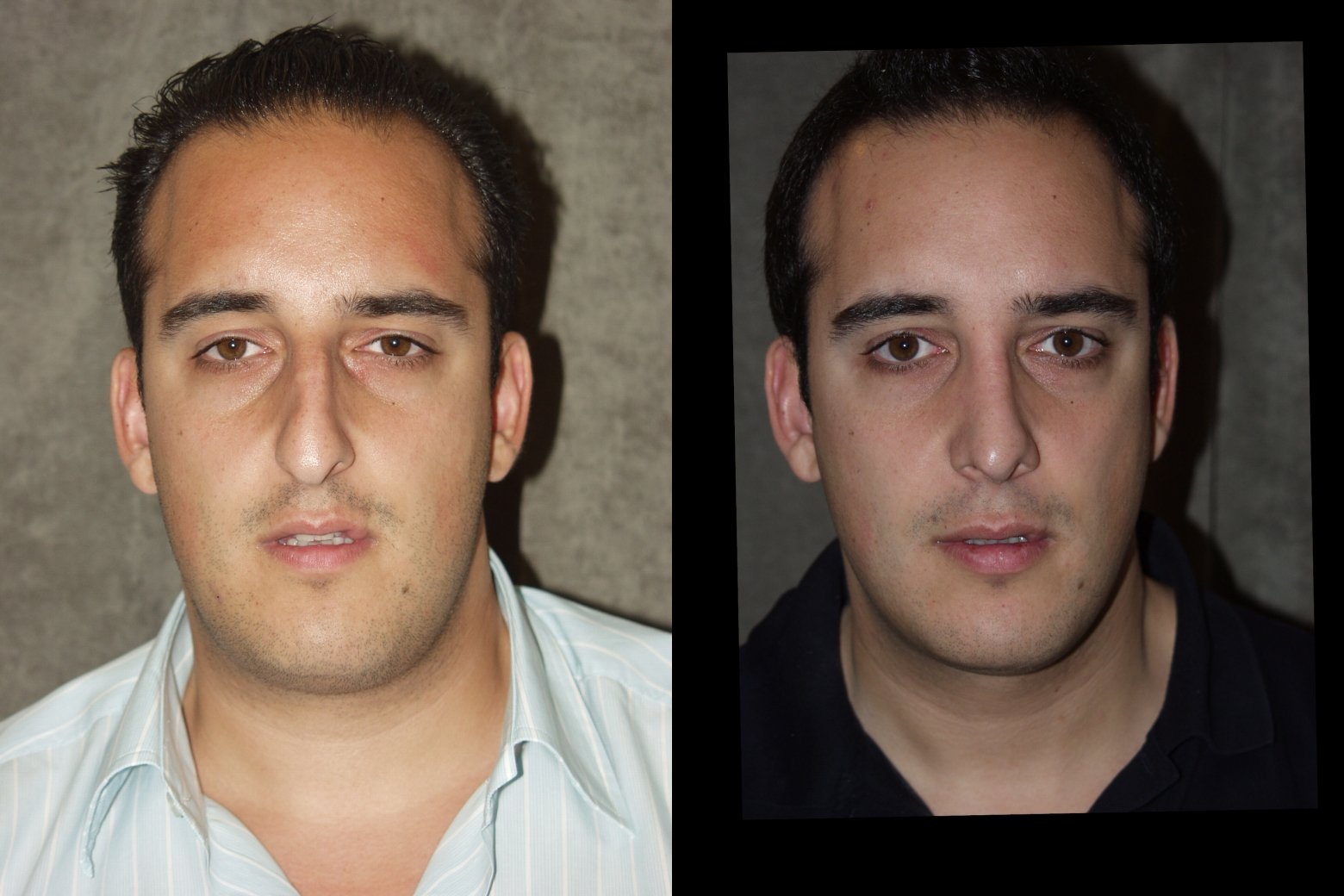Rhinoplasty before and after photographs, case 5, with the before photograph on the left and the after photograph on the right