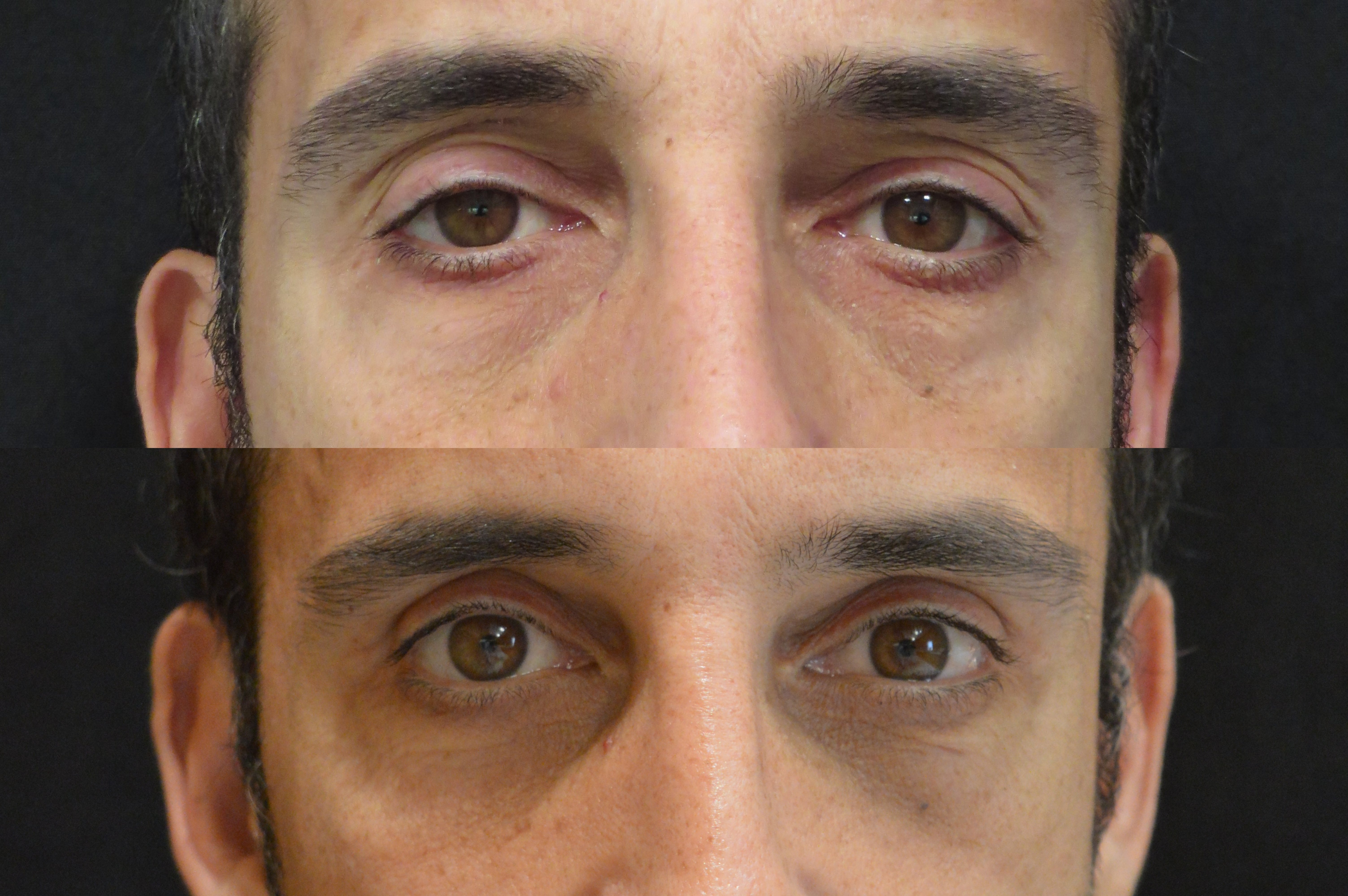 Blepharoplasty before and after photographs, case 10, with the before photograph on top and the after photograph below