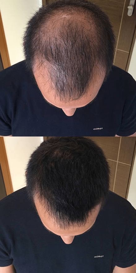 Hair PRP Treatment