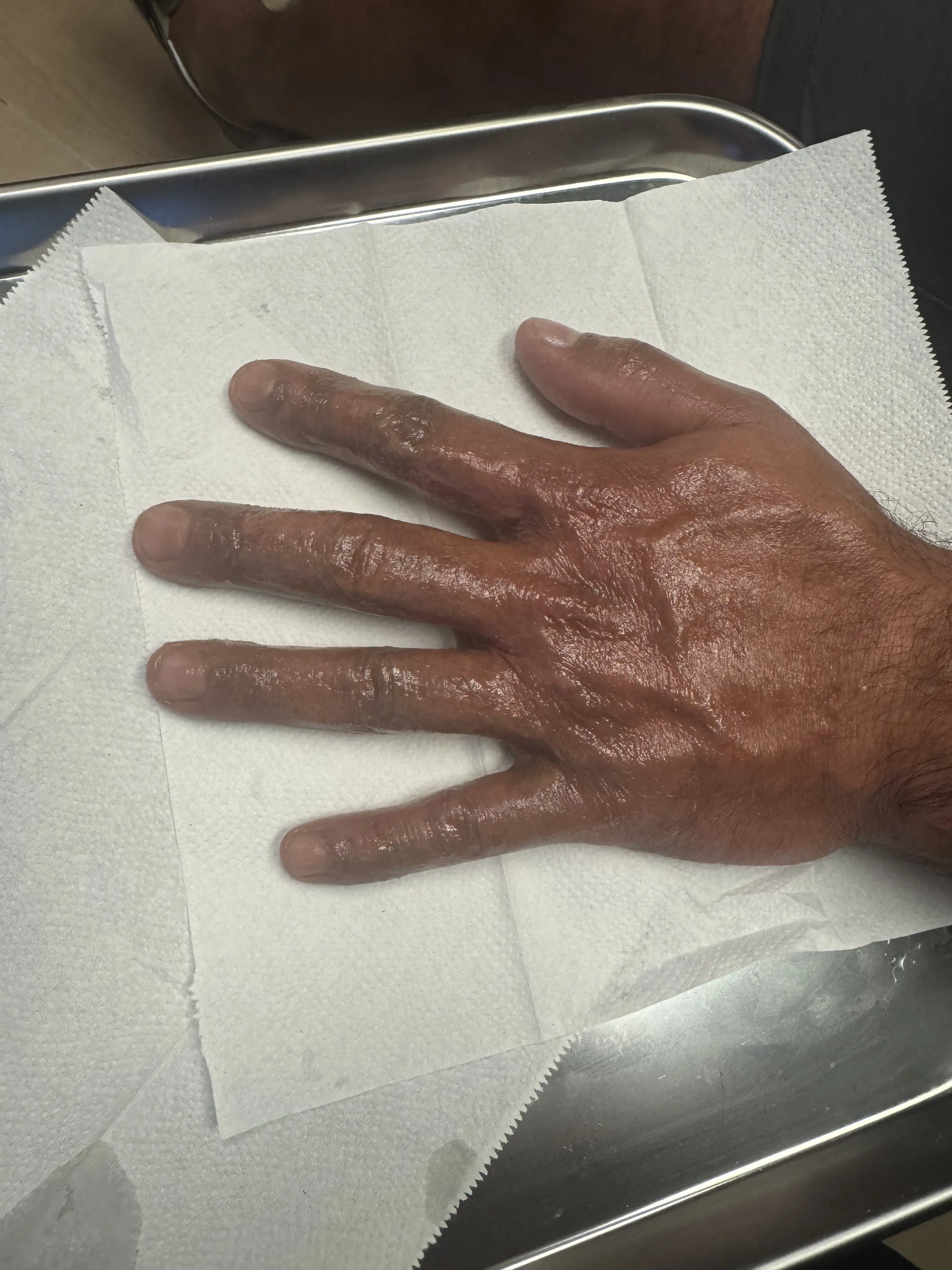 Hand after scar revision treatment