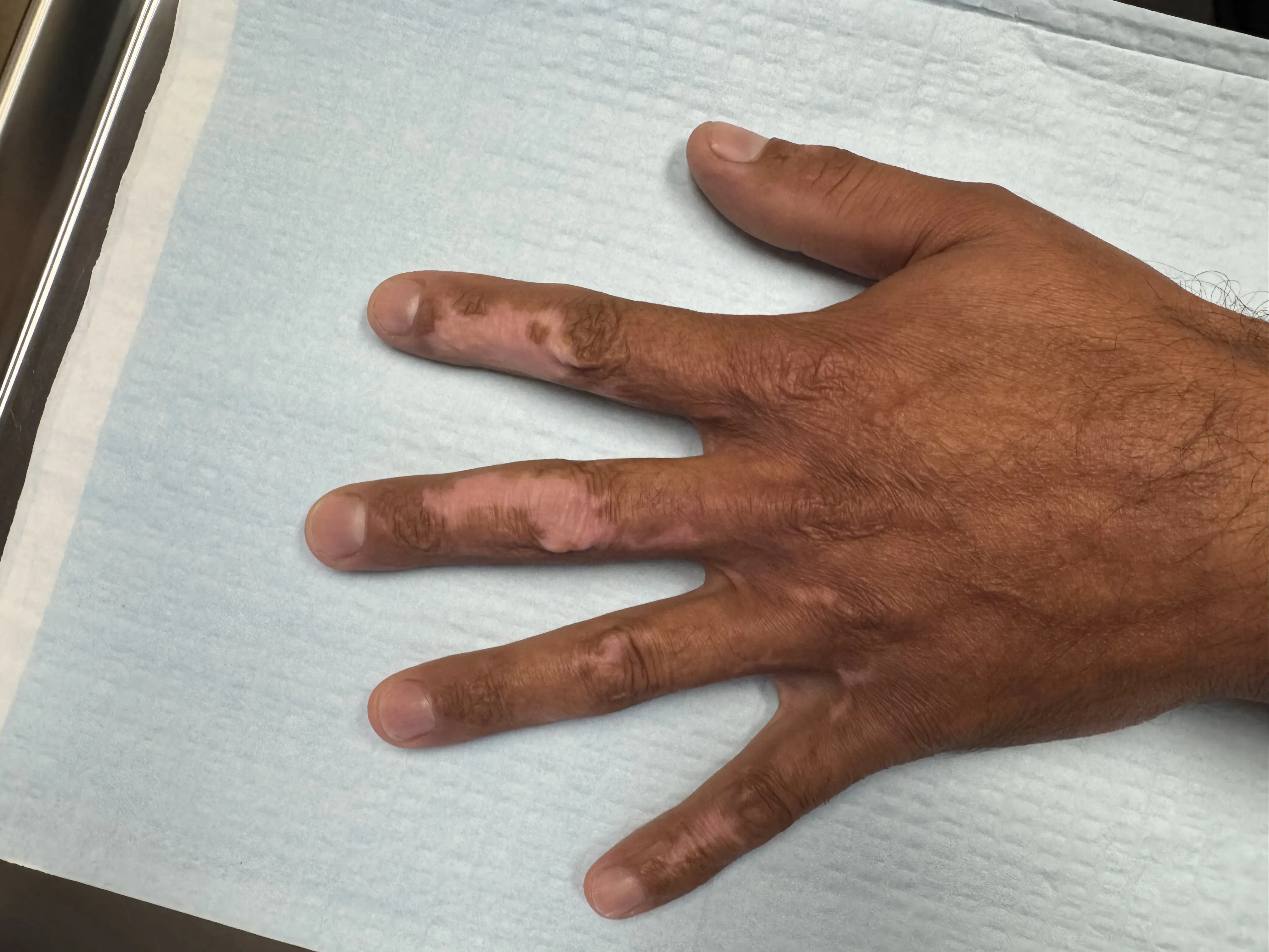 Scar Revision — Hand