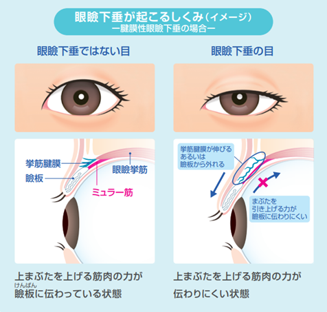 眼瞼下垂が起こるしくみ