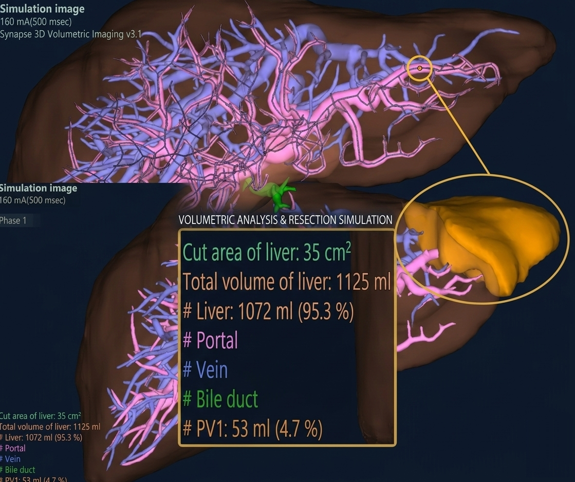 Vascular Territory Volume Analysis - 혈관 구역 선택에 따른 Volume 분석