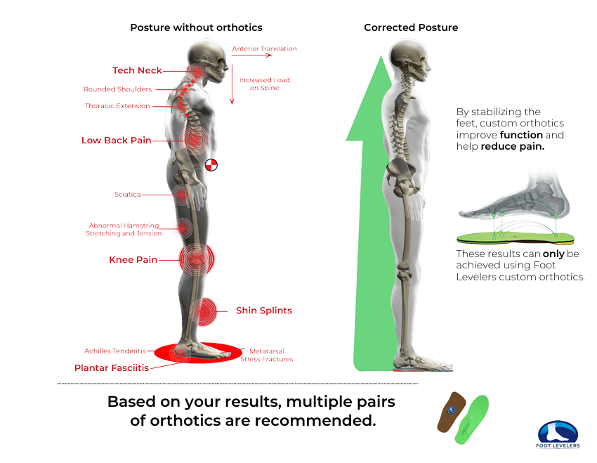 Posture correction with custom orthotics showing before and after skeletal alignment