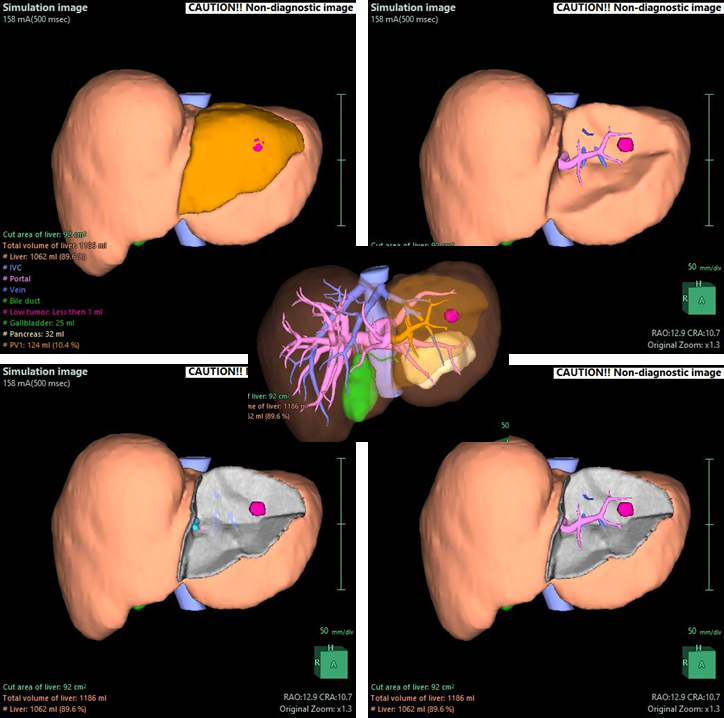 Pre-operative Simulation