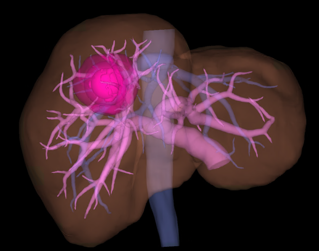 Tumor Margin 설정