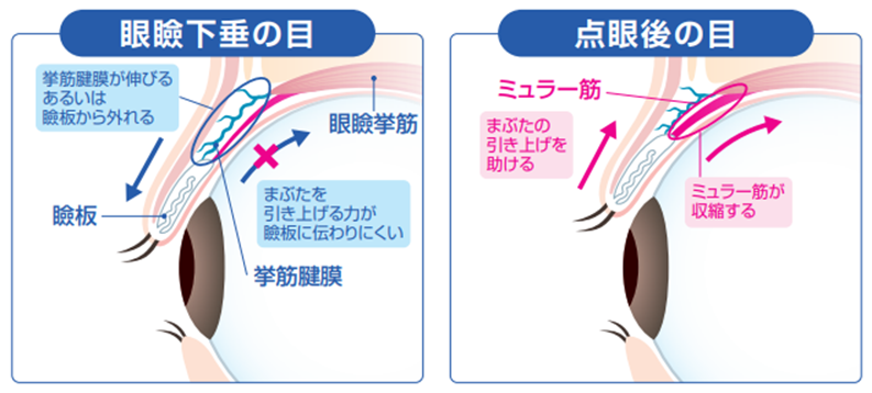 眼瞼下垂と点眼後の目の比較