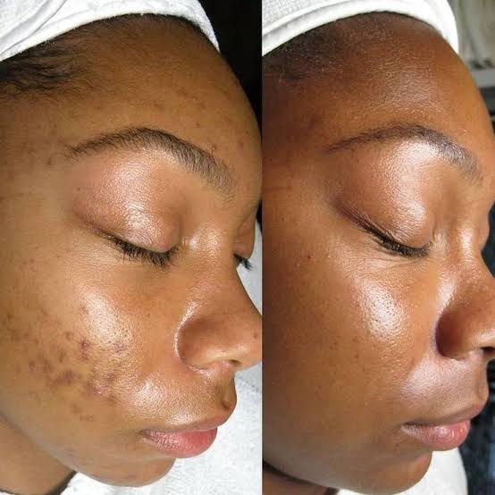 Before and after hyperpigmentation treatment