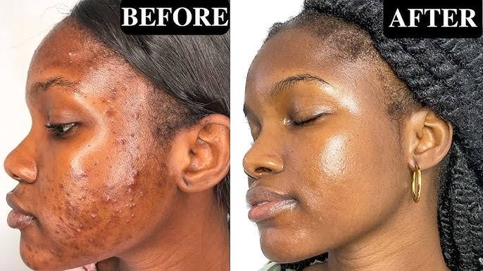 Before and after acne treatment
