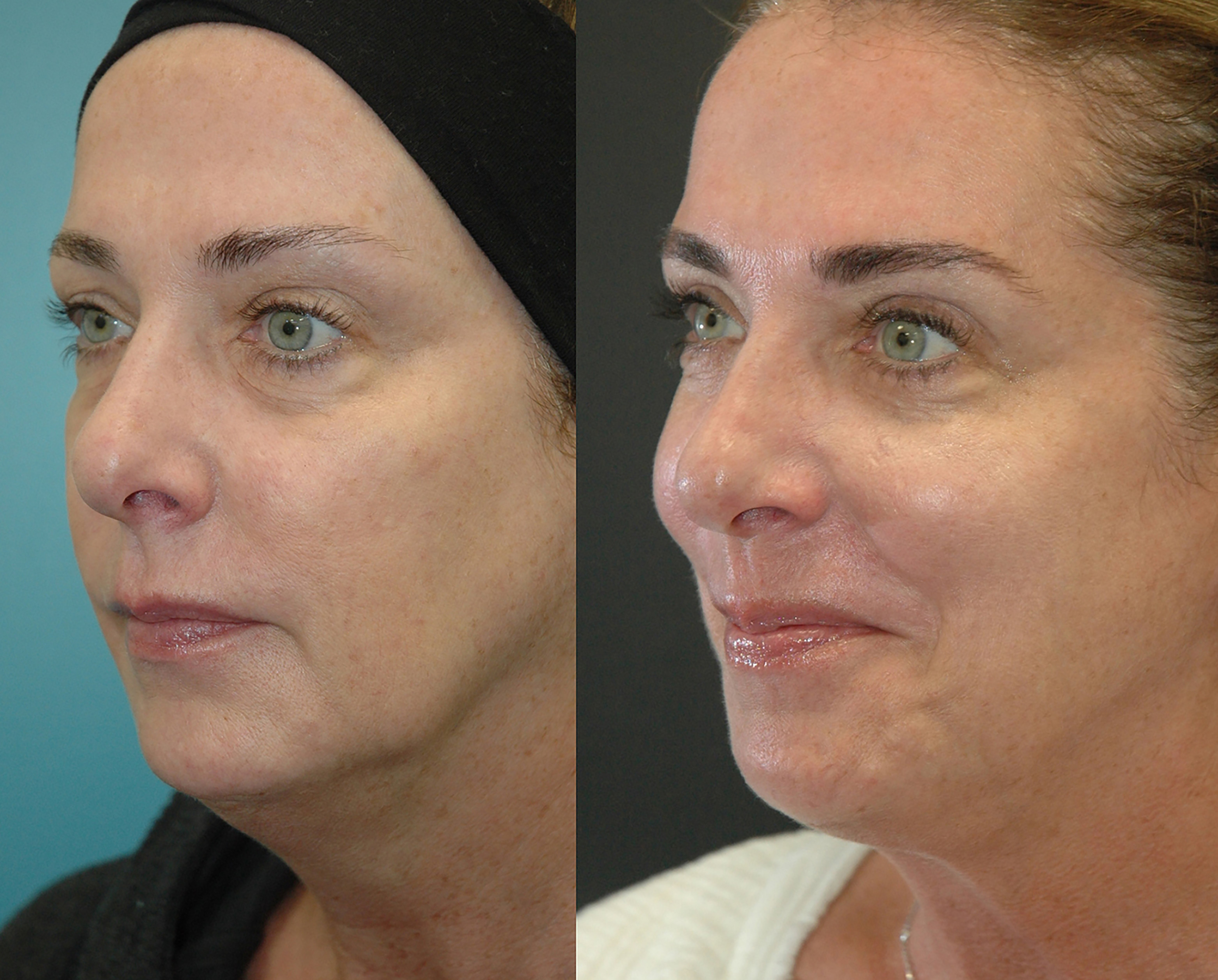Morpheus8 with FaceTite before and after photographs, case 10, with the before photograph on the left and the after photograph on the right
