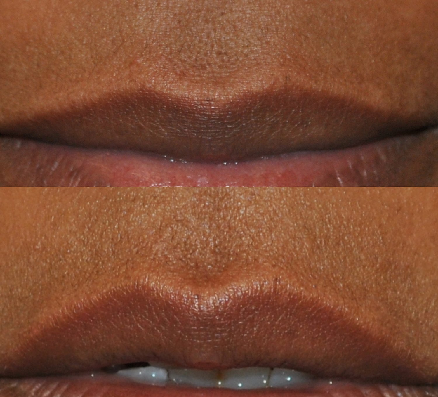 Lip flip before and after photographs, case 2, with the before photograph on top and the after photograph below