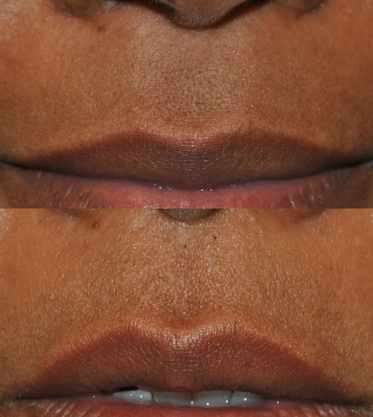 Lip flip before and after photographs, case 1, with the before photograph on top and the after photograph below