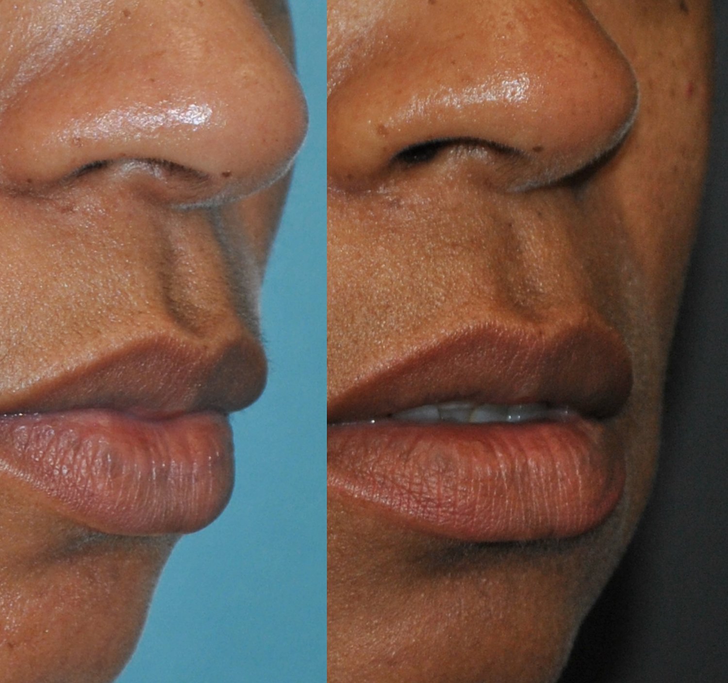 Lip flip before and after photographs, case 3, with the before photograph on the left and the after photograph on the right