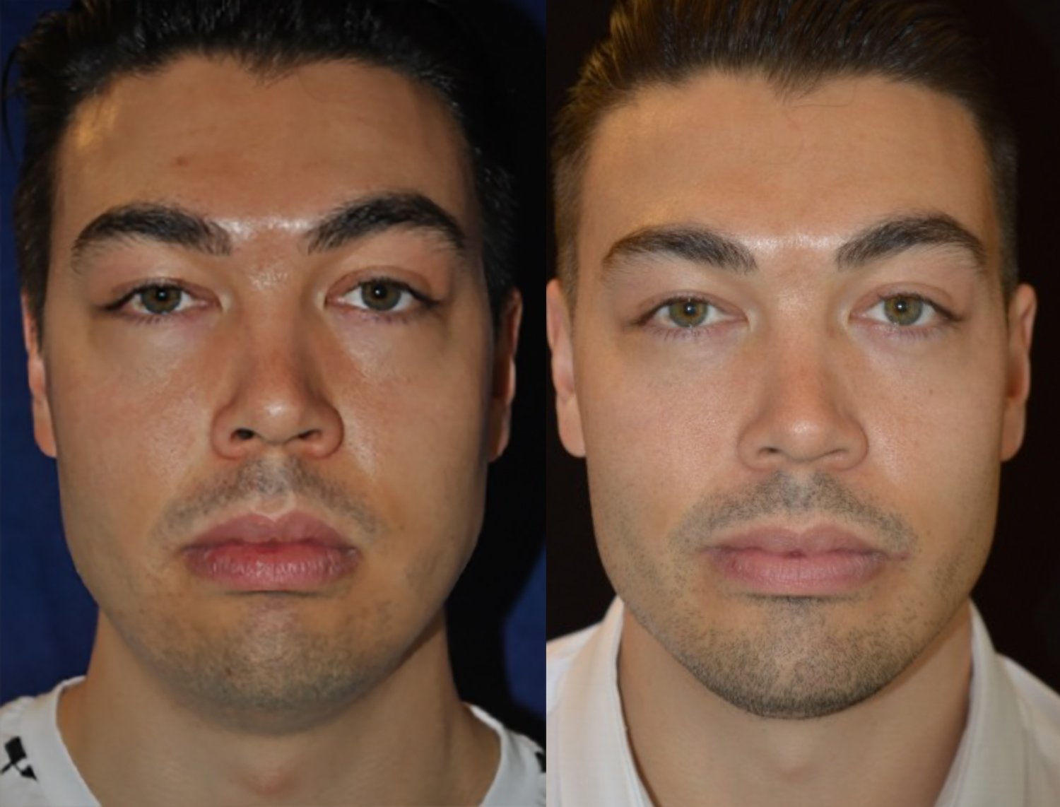 Dr. Kirwan patient result — Dr. Laurence Kirwan. Male patient, square chin implant with buccal fat removal, front view. Before: left; After: right.