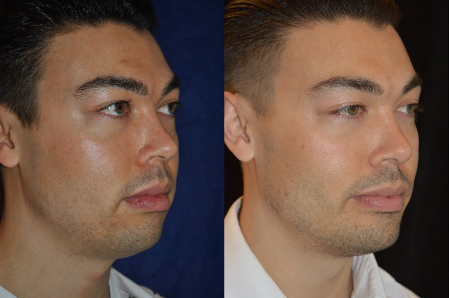Dr. Kirwan patient result — Dr. Laurence Kirwan. Male patient, square chin implant with buccal fat removal, oblique view. Before: left; After: right.