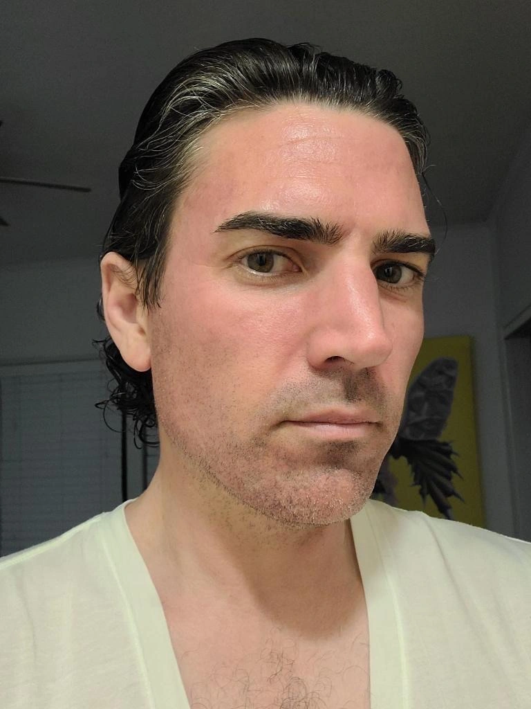 Microneedling — Male Treatment Sequence