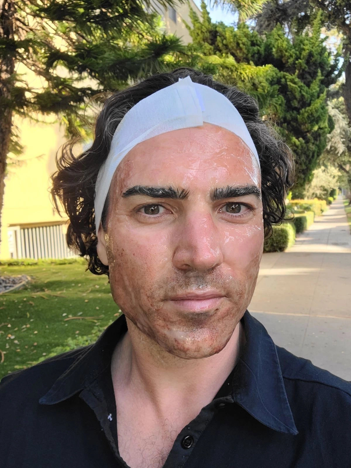 Male client healing process after microneedling