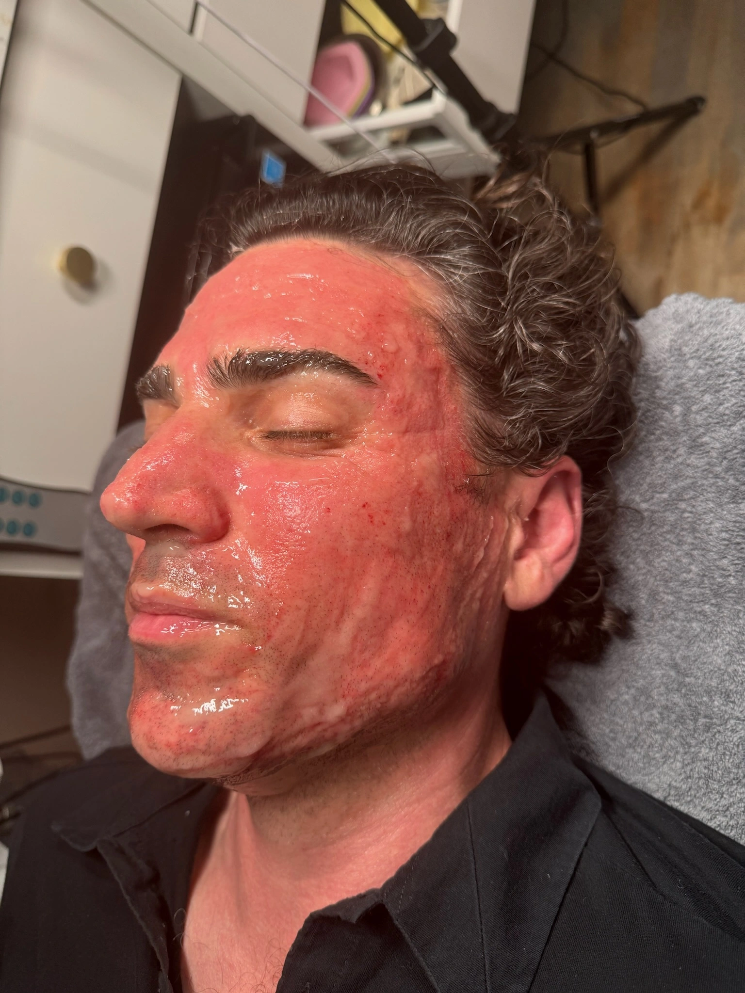 Male client during microneedling — redness immediately after