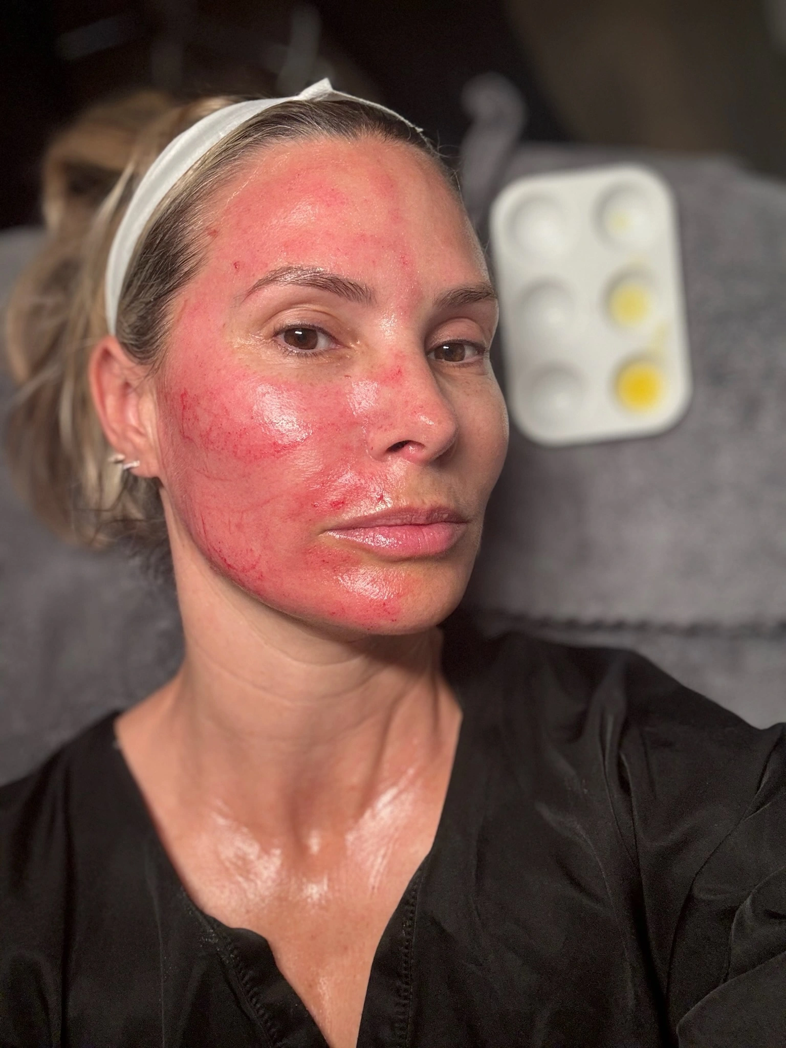 Female client post-microneedling on treatment table