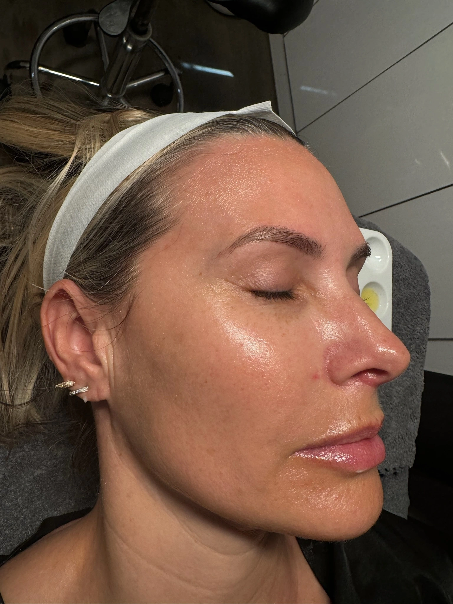 Female client after microneedling — glowing hydrated skin