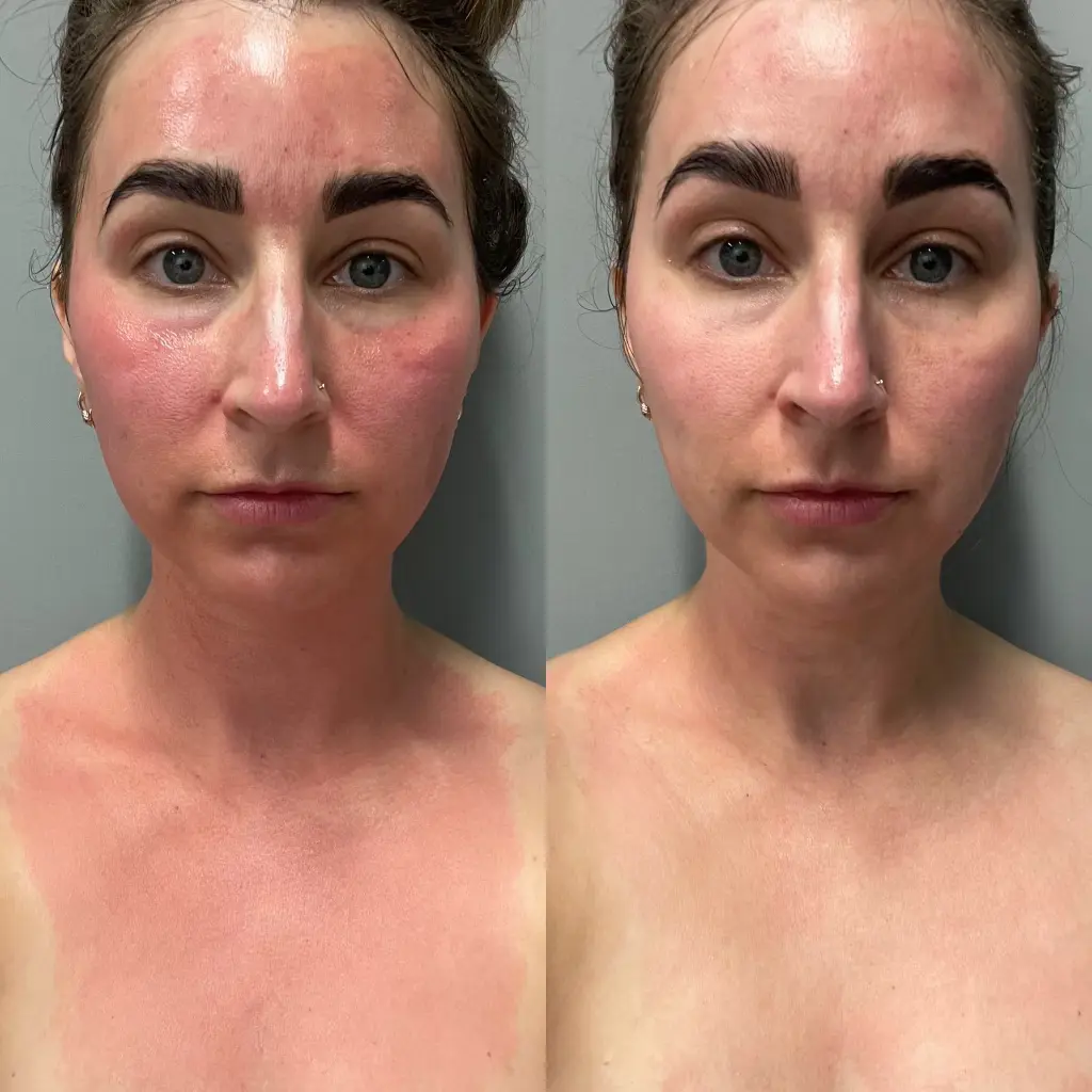 Microneedling — Redness & Texture