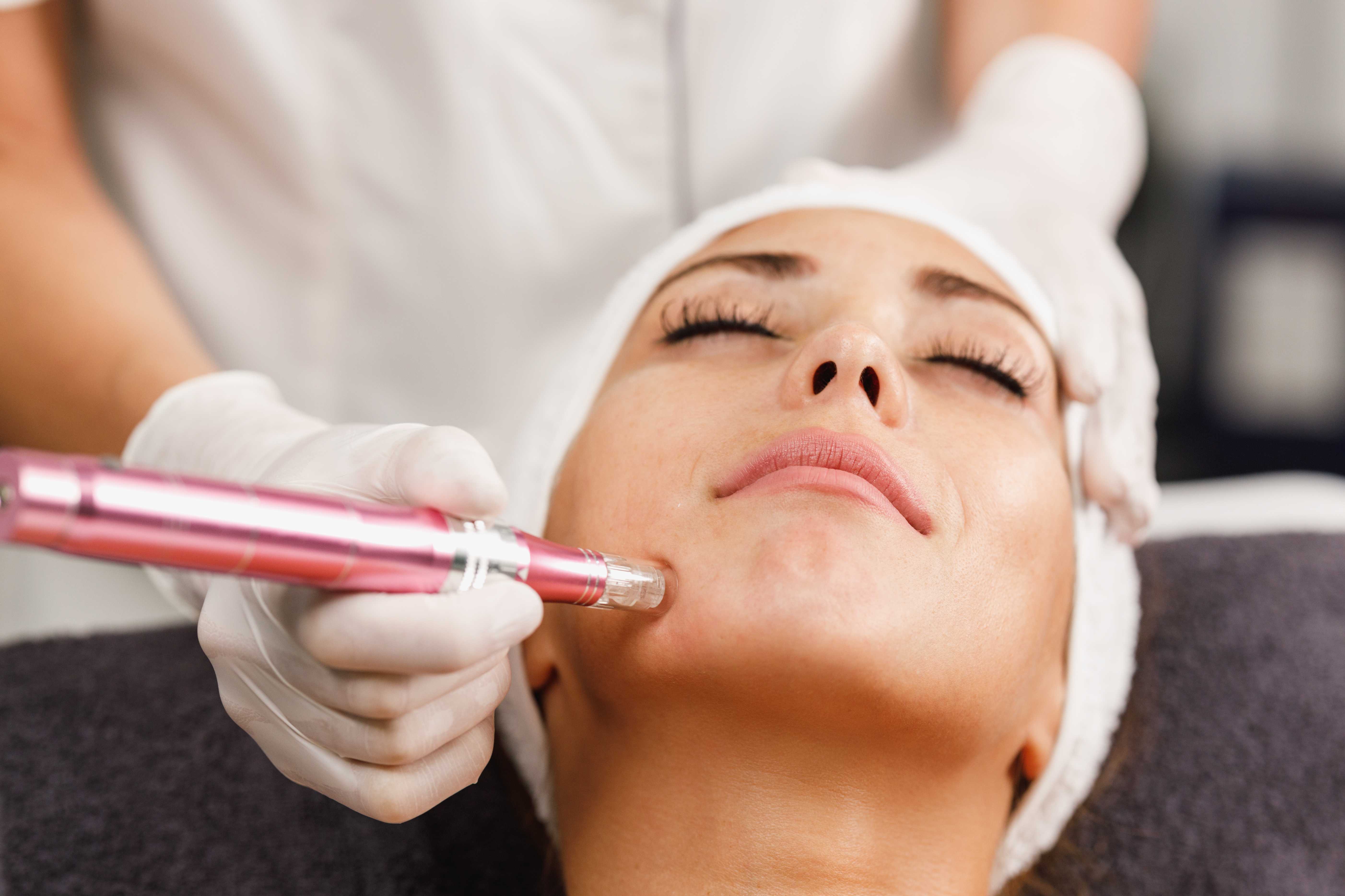 Microneedling