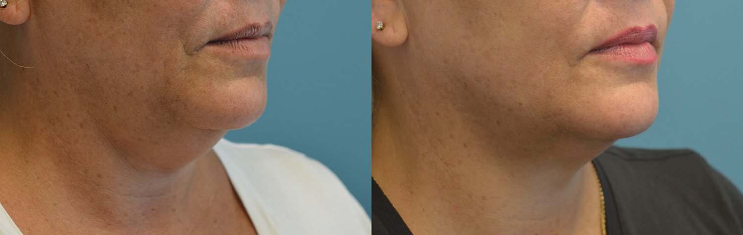 Morpheus8 with FaceTite before and after photographs, case 2, with the before photograph on the left and the after photograph on the right