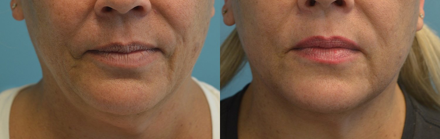 Morpheus8 with FaceTite before and after photographs, case 1, with the before photograph on the left and the after photograph on the right