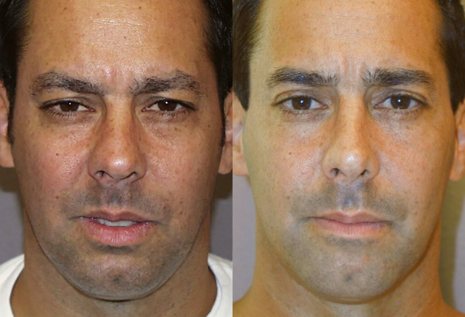 Rhinoplasty before and after photographs, case 9, with the before photograph on the left and the after photograph on the right