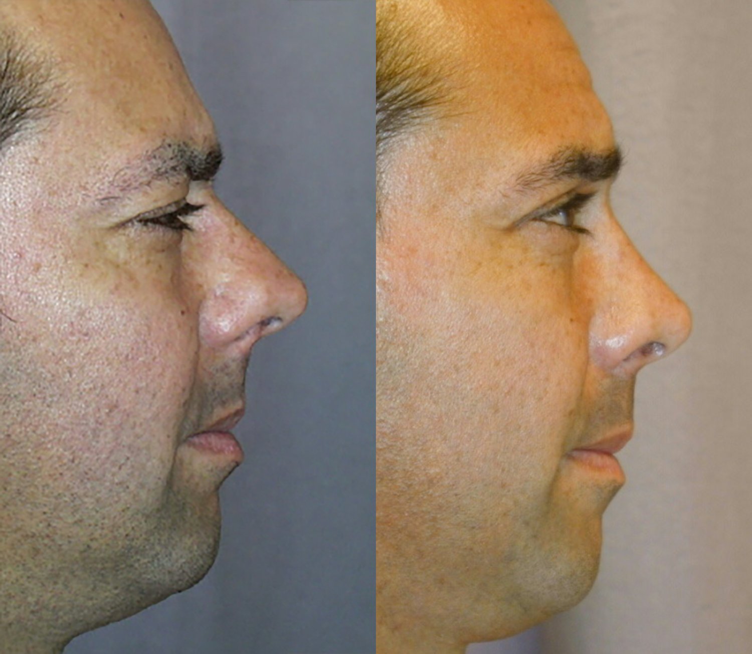 Rhinoplasty before and after photographs, case 10, with the before photograph on the left and the after photograph on the right