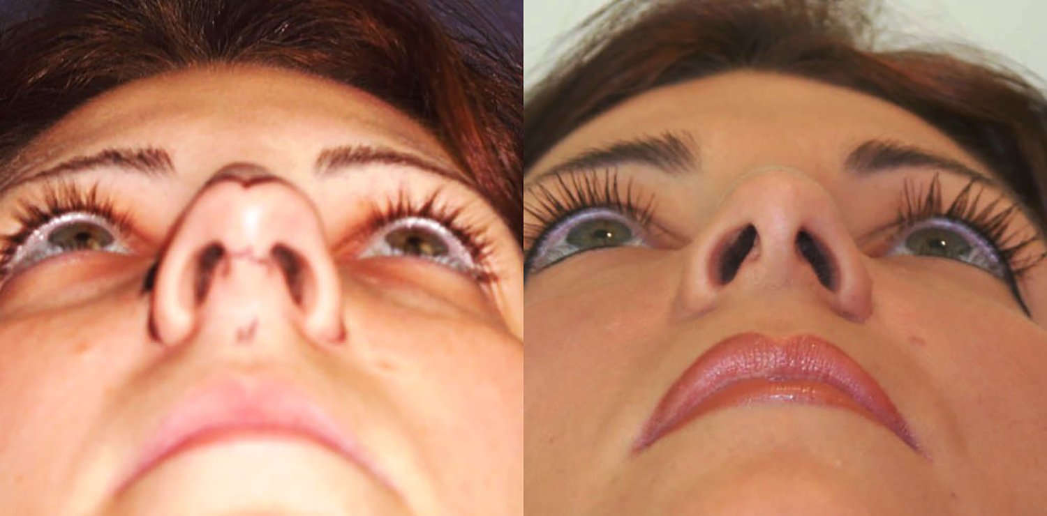 Dr. Kirwan patient result — Dr. Laurence Kirwan. Open rhinoplasty, view from below. Before: left; After: right.