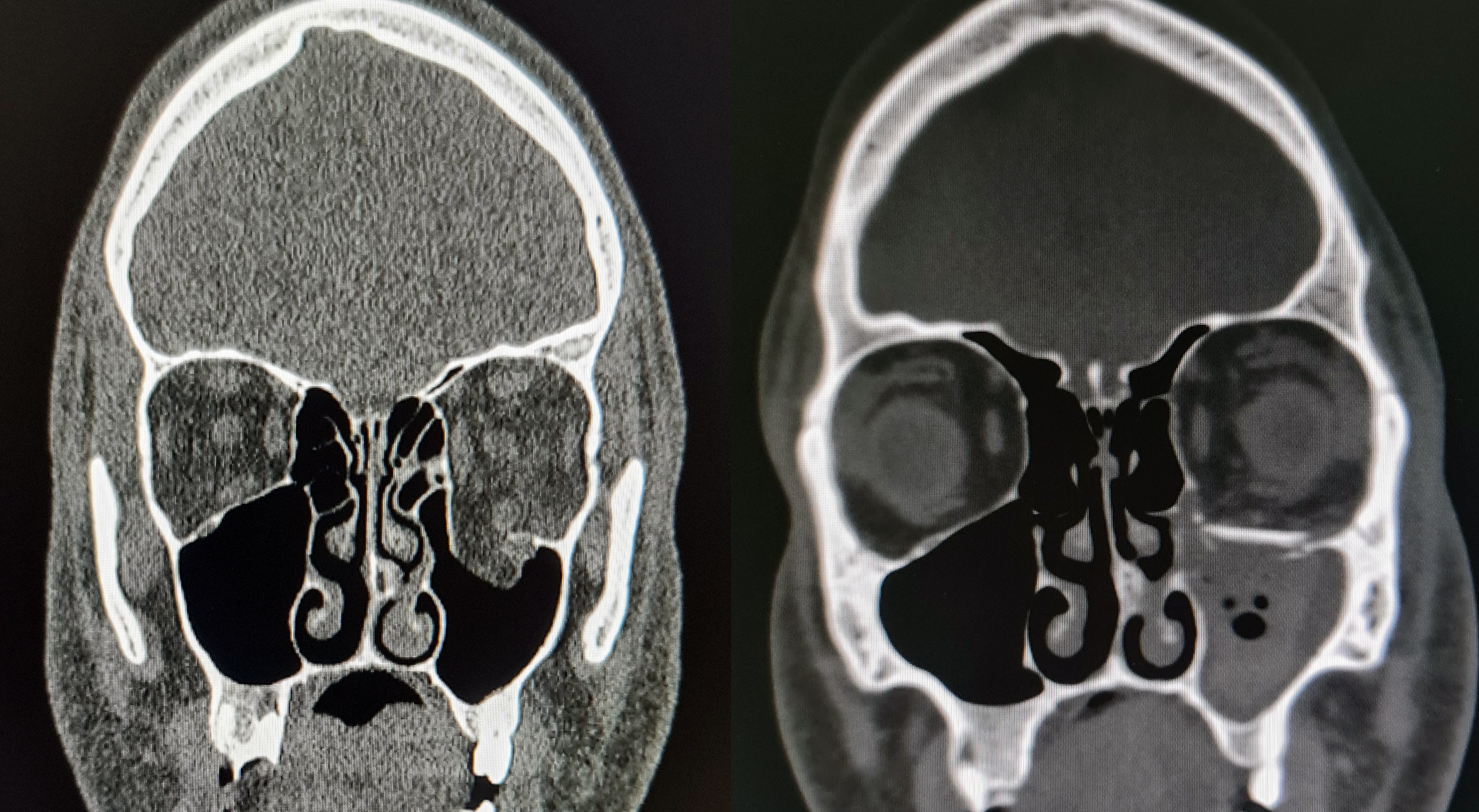 Maksillofasiyal Cerrahi