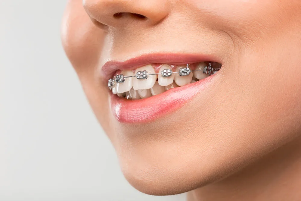 Orthodontic treatment