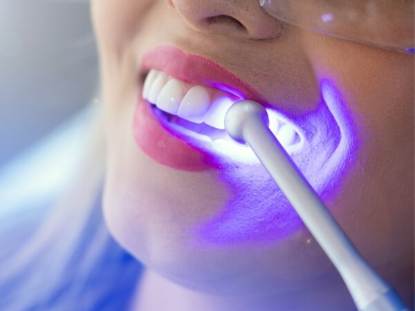 Clareamento dental profissional com luz LED