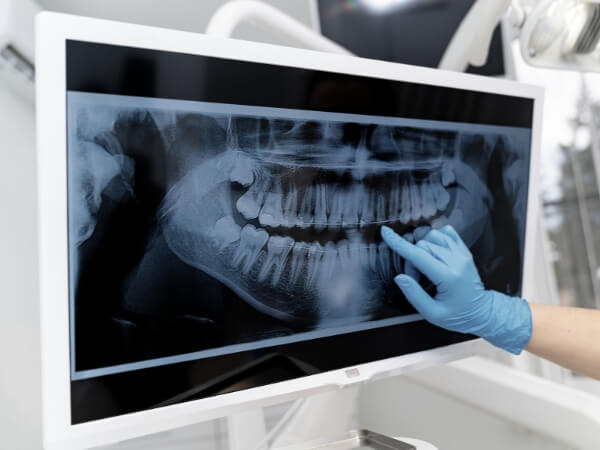 Planejamento digital de implantes