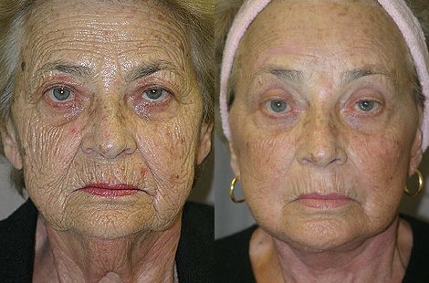 Peri-oral chemical peel before and after photographs, case 1, with the before photograph on the left and the after photograph on the right