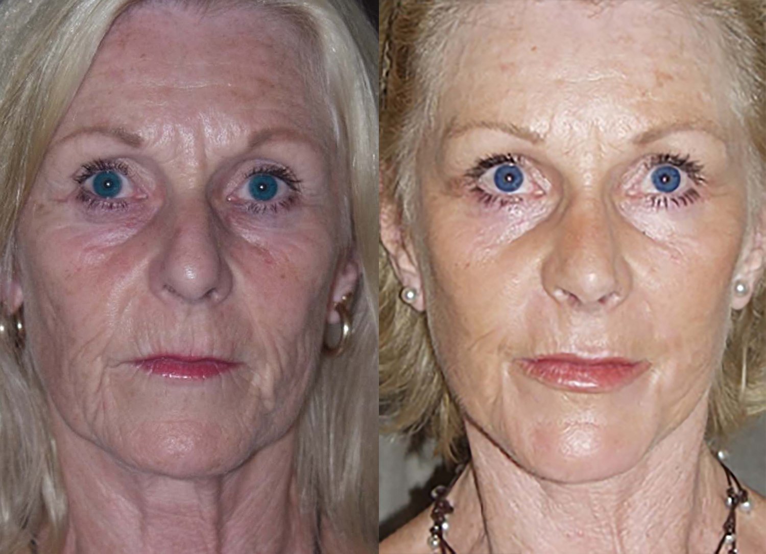 Peri-oral chemical peel before and after photographs, case 2, with the before photograph on the left and the after photograph on the right