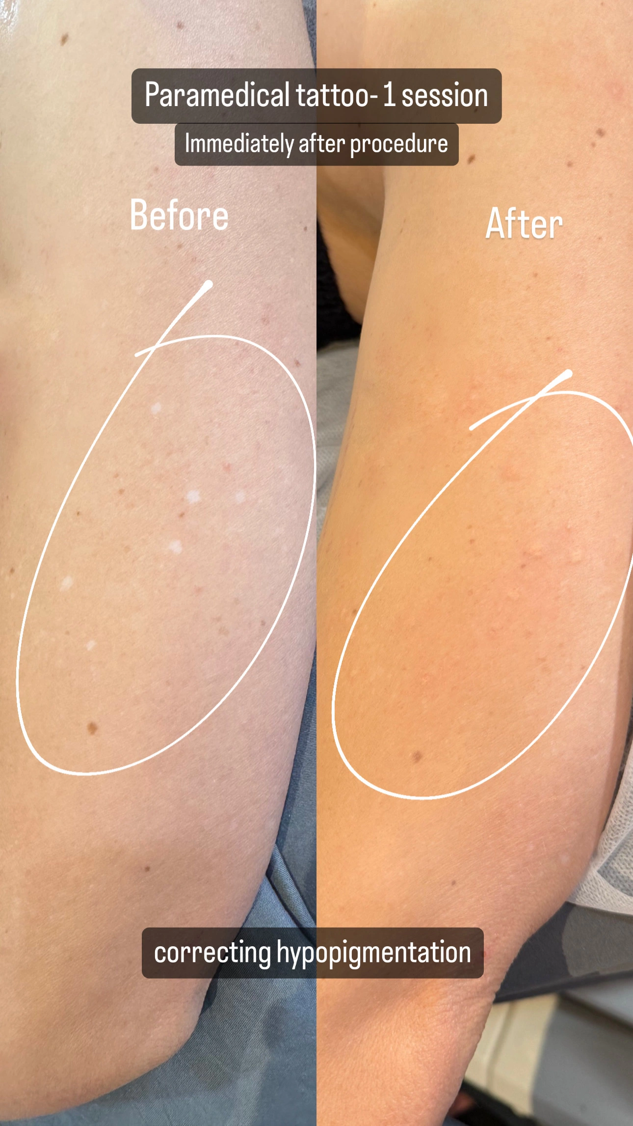 Paramedical Tattoo — Hypopigmentation