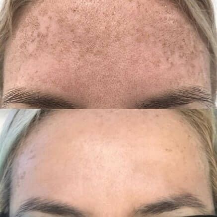 Pigmentation before and after
