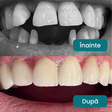 Tratament dentar înainte și după - Caz 1